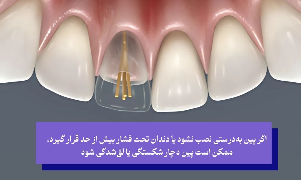 معایب و محدودیت‌های پین دندان