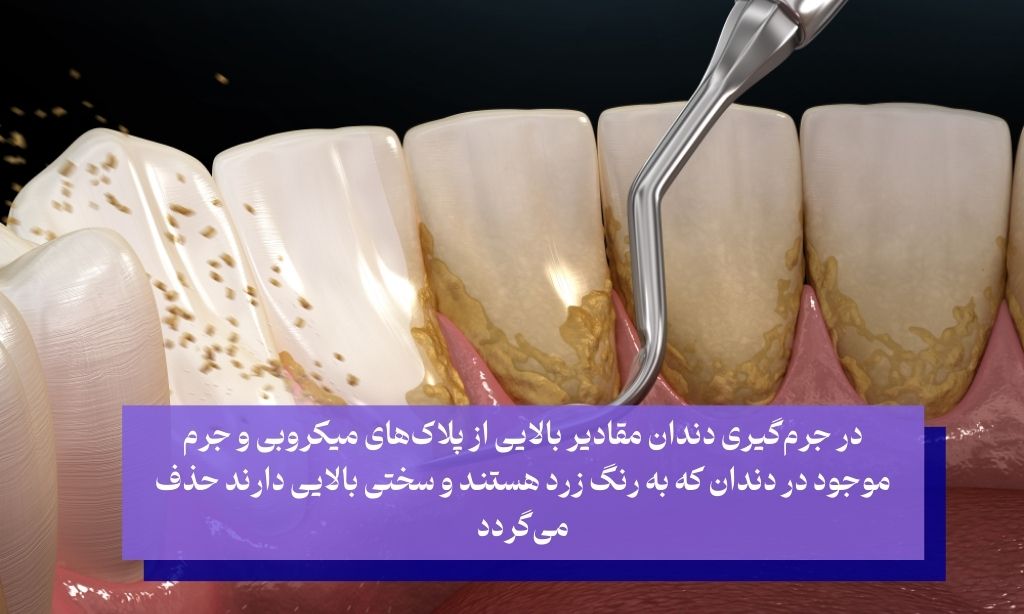 تفاوت جرمگیری و بروساژ