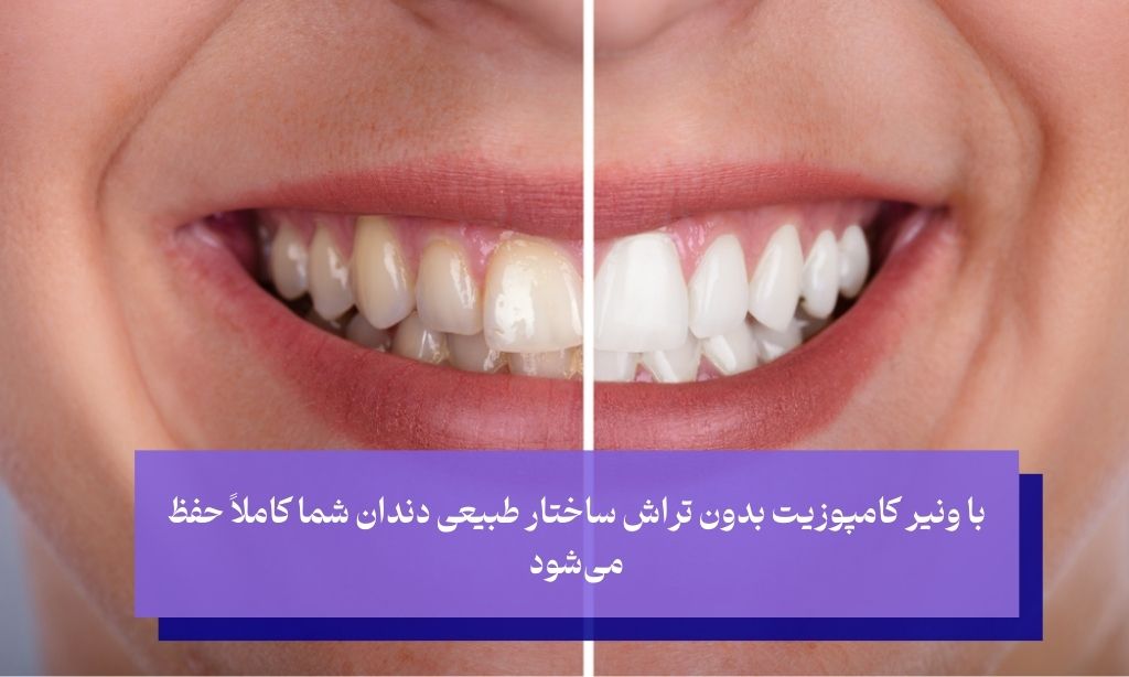 مزایای ونیر کامپوزیت بدون تراش