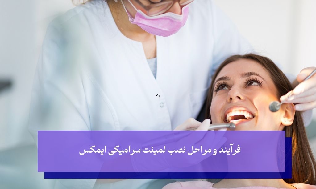 فرآیند نصب لمینت سرامیکی ایمکس