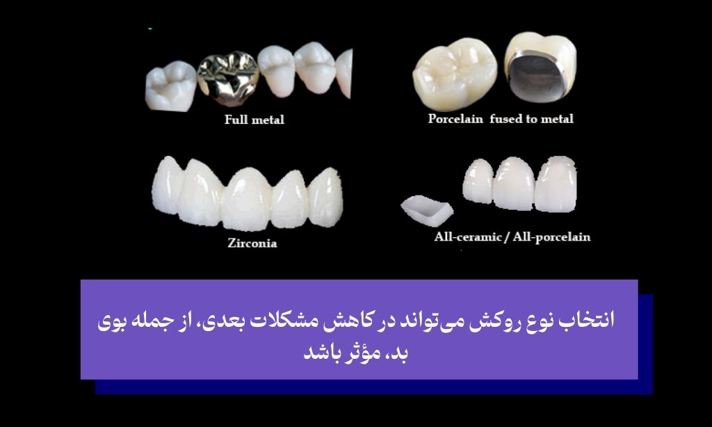 آیا نوع روکش دندان بر ایجاد بوی بد تأثیر دارد؟