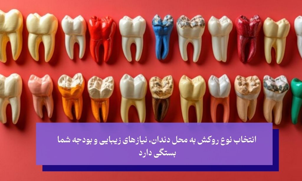 انواع روکش دندان و نقش آن‌ها در مقاومت در برابر شکستگی