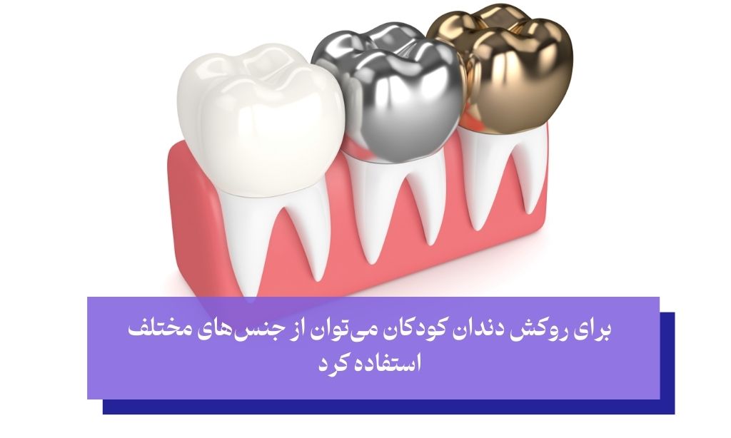 انواع روکش دندان کودکان