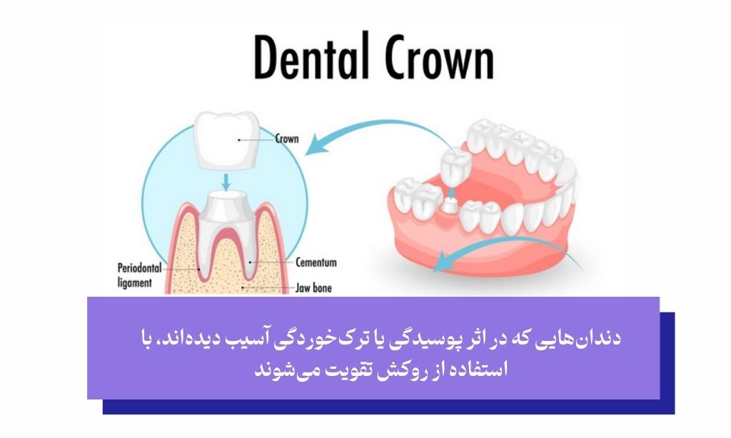 روکش دندان چیست