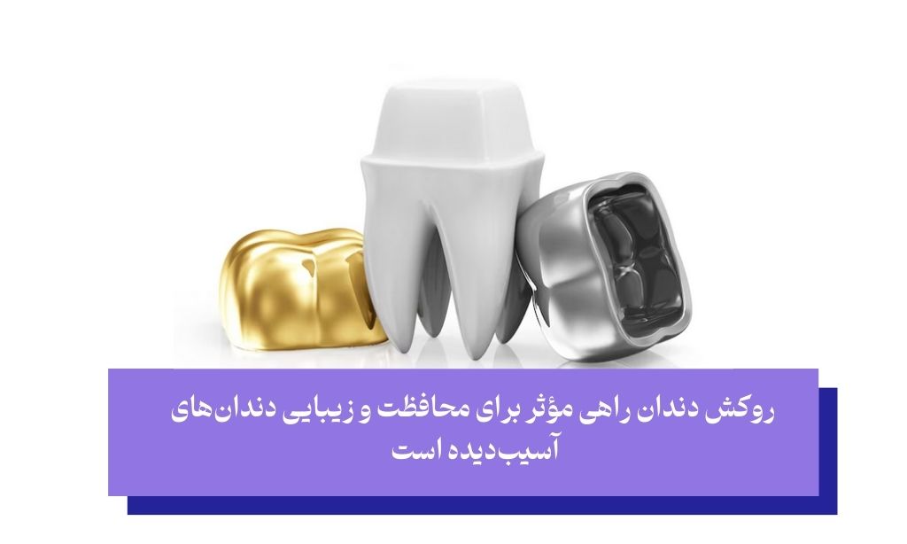 روکش دندان چیست