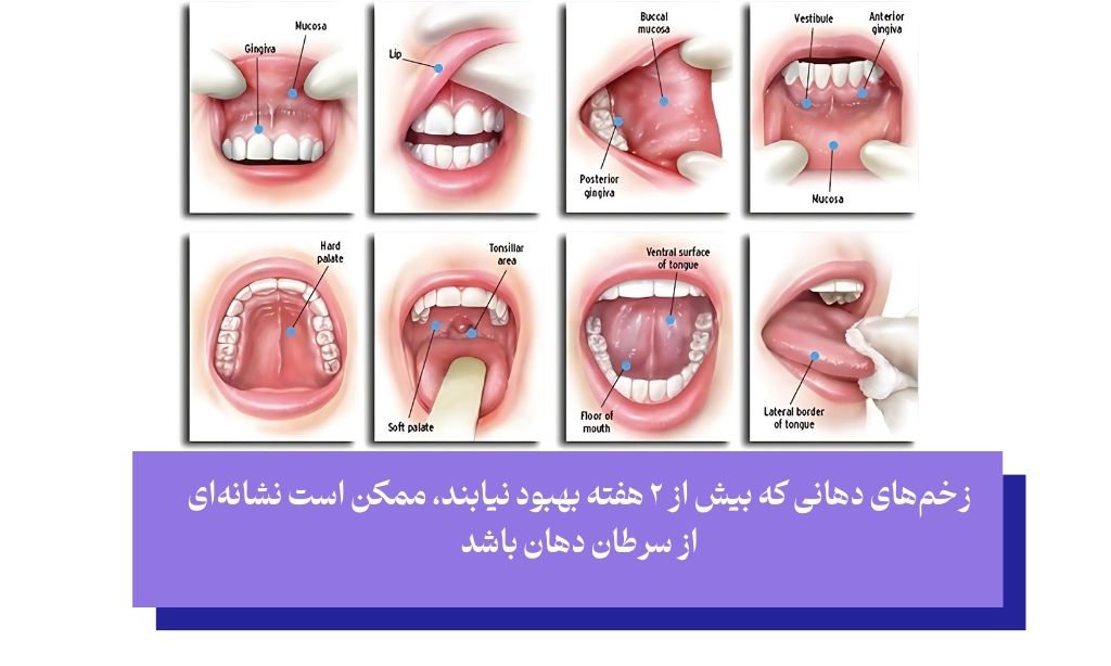 زخم‌های دهانی که بهبود نمی‌یابند؛ از اولین علائم سرطان دهان گلو