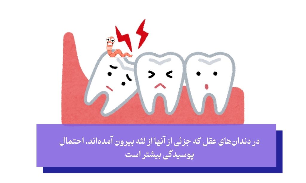 عاملی که جراحی دندان عقل نهفته افقی فک پایین ضروری می‌سازند