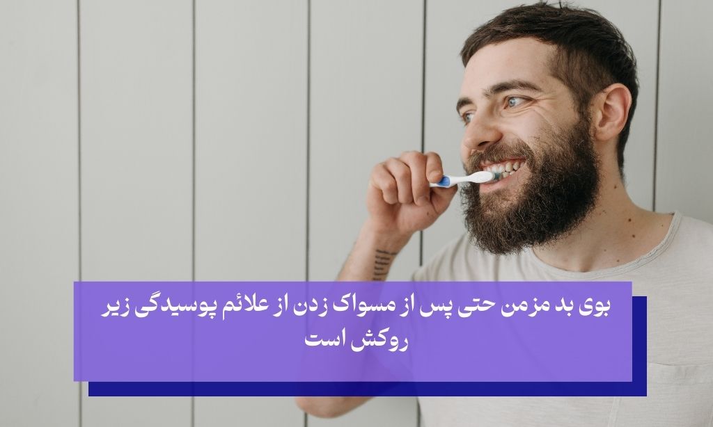 علائم پوسیدگی زیر روکش