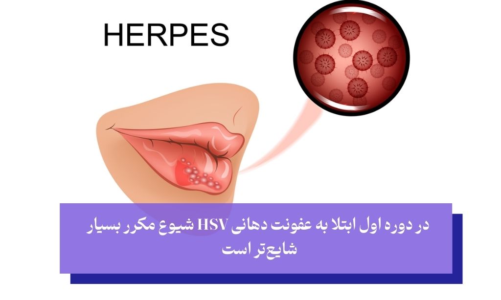 علل ابتلا به تبخال دهان