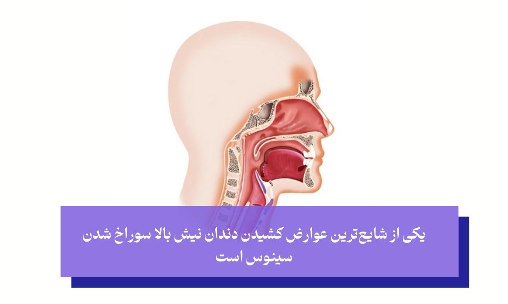 عوارض نادر اما خطرناک کشیدن دندان