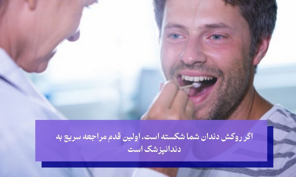 مراحل ترمیم روکش دندان شکسته