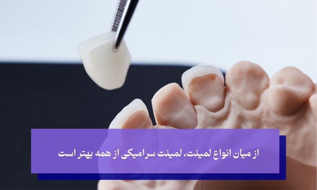 بهترین نوع لمینت دندان چیست