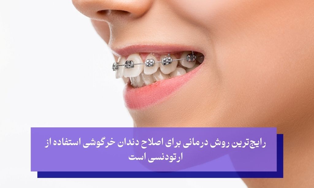 رایج‌ترین روش درمانی دندان خرگوشی