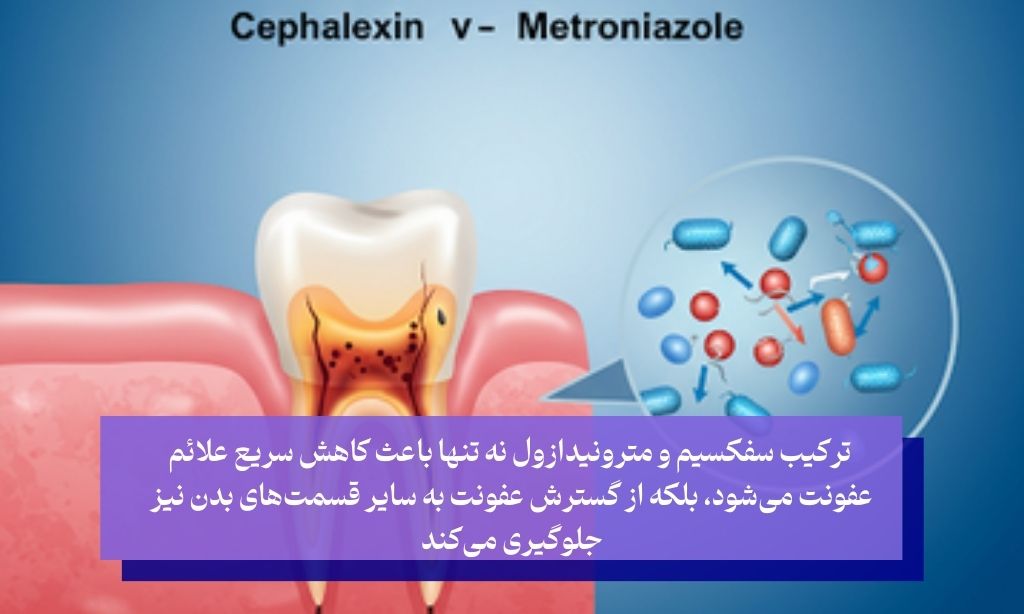 ترکیب سفکسیم و مترونیدازول برای عفونت دندان: ترکیبی مؤثر یا خطرناک است؟