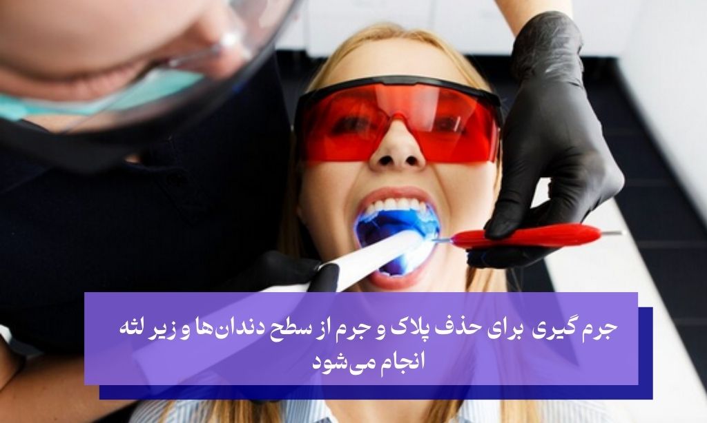 جرم گیری دندان چیست و چرا انجام می‌شود؟