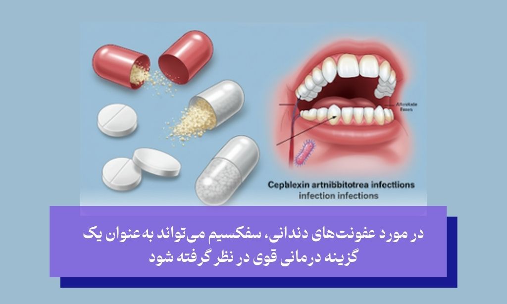 سفکسیم برای عفونت دندان