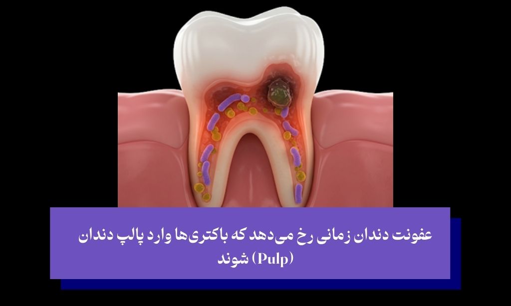 عفونت دندان دقیقاً چیست و چرا خطرناک است؟