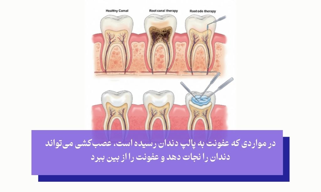 چگونه می‌توان عفونت دندان را به بهترین شکل درمان کرد