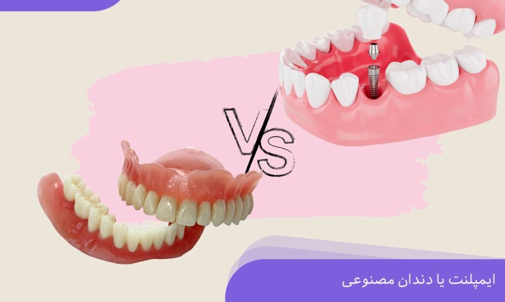 ایمپلنت یا دندان مصنوعی