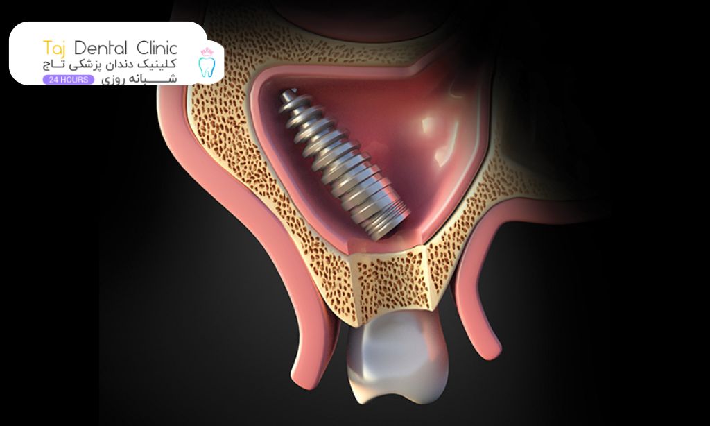افتادن ایمپلنت داخل سینوس