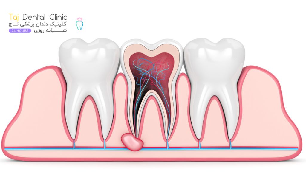 درد دندان بعد از عصب کشی