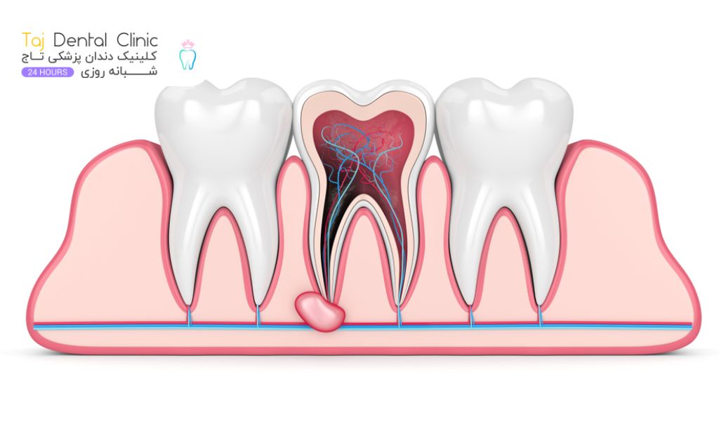 آبسه دندان عصب کشی شده