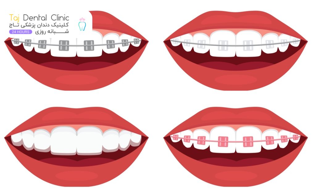 انواع ارتودنسی