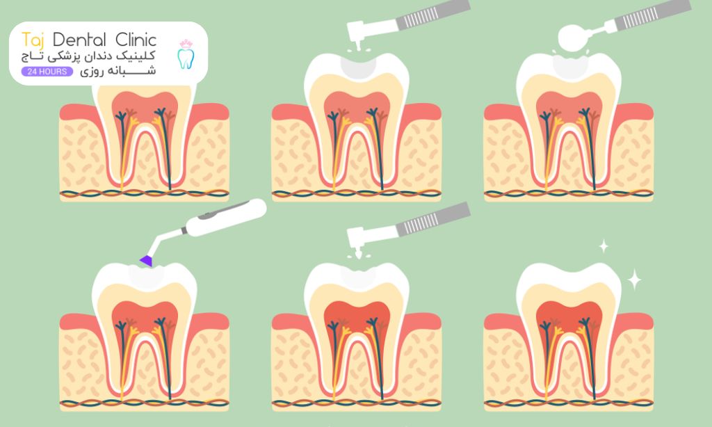 مراحل پر کردن دندان